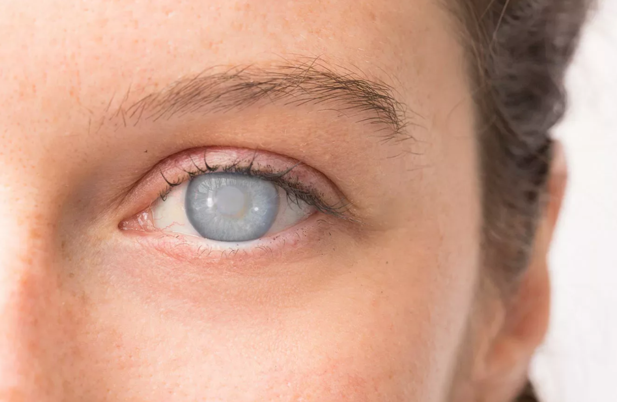 Is There a Way to Treat Cataracts Without Surgery